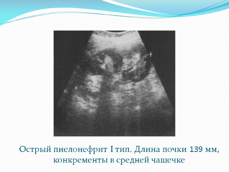 Острый пиелонефрит I тип. Длина почки 139 мм, конкременты в средней чашечке